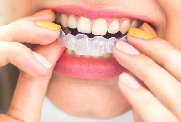 Dental Night Guard - Dr. Mistry Dentistry