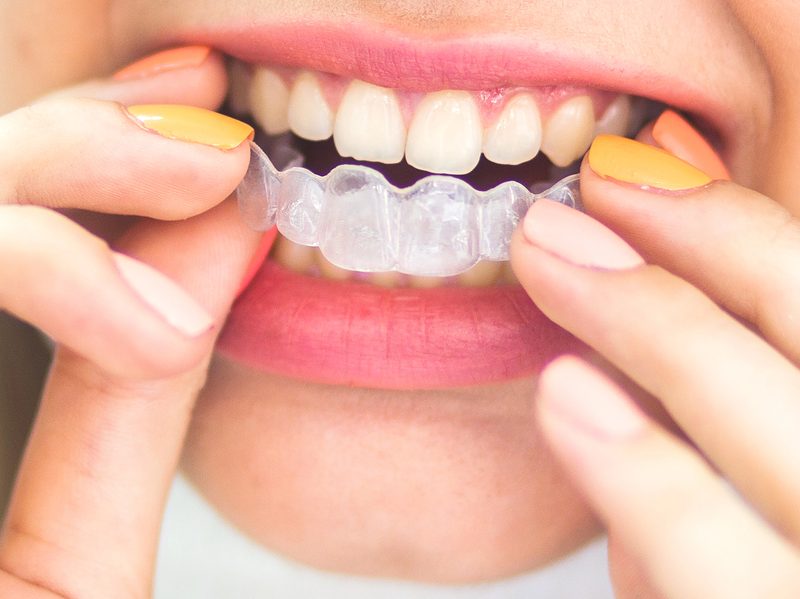 Dental Night Guard - Dr. Mistry Dentistry