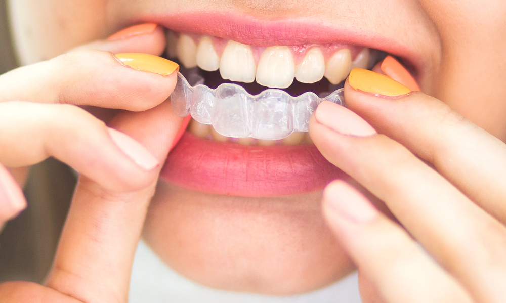 Here’s why you might need a dental night guard