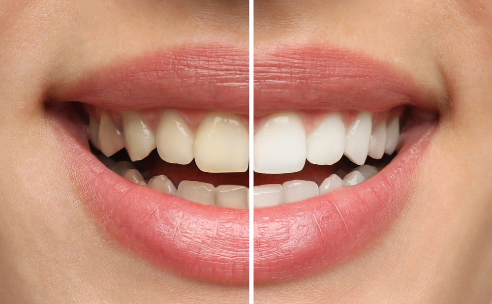5 Common Cosmetic Dentistry Solutions in Guelph