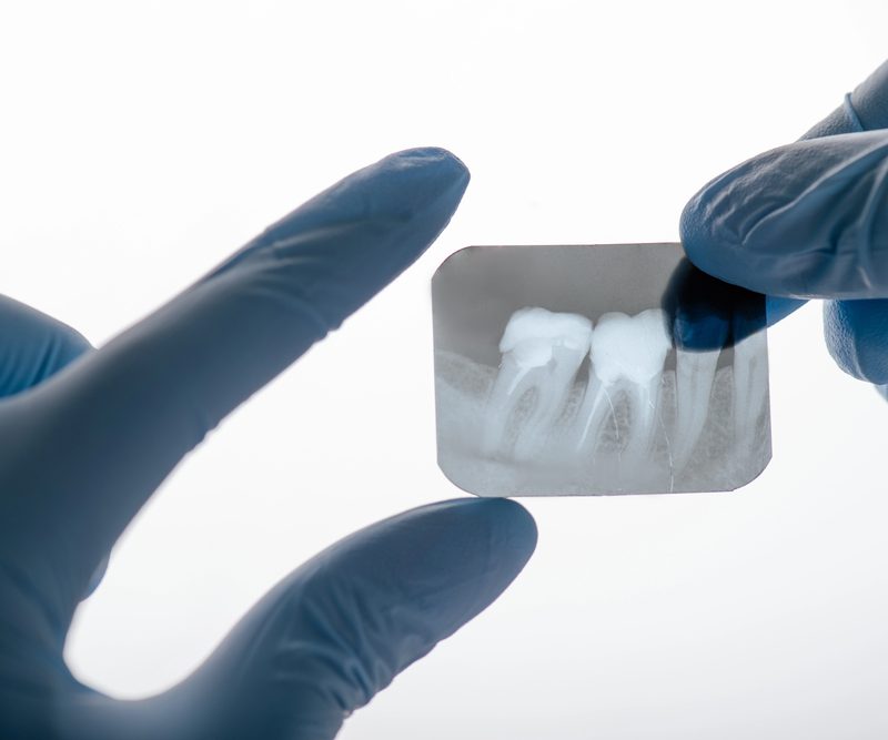 dental x-rays