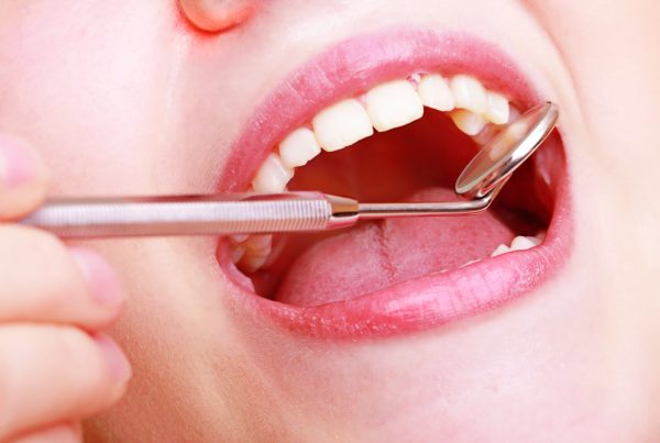 Dental Crowns and Bridges Dr. Mistry Dentistry