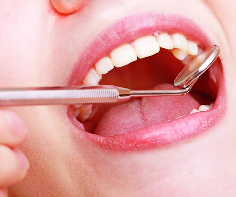Dental Crowns and Bridges Dr. Mistry Dentistry