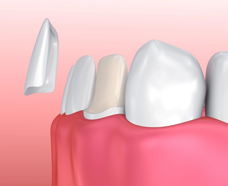 Porcelain Veneers