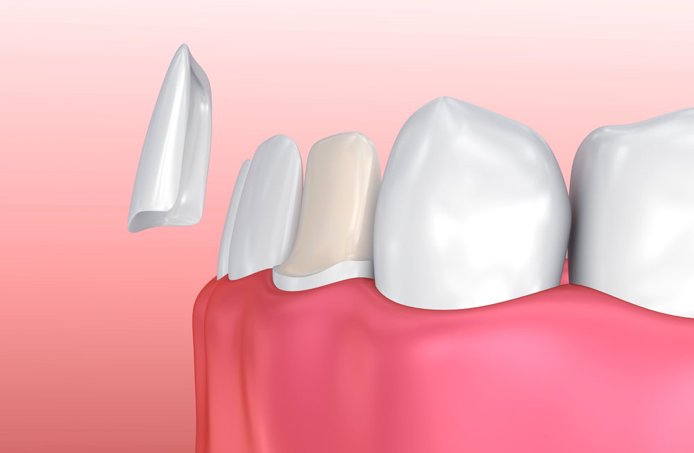 How Long Do Invisalign Treatments Take to Work?