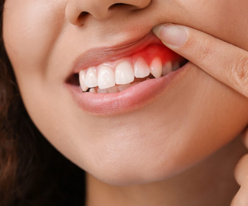 Periodontal Diseases Dr. Mistry Dentistry