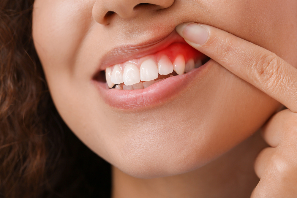 Are You Getting Periodontal Gum Surgery? Here’s What to Expect from Your Recovery