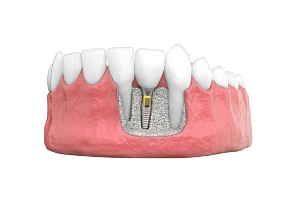 Bone Grafting Procedures Guelph Dr. Mistry Dentistry