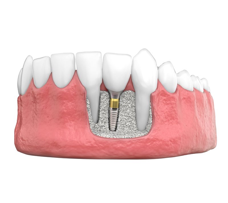 Bone Grafting Procedures Guelph Dr. Mistry Dentistry