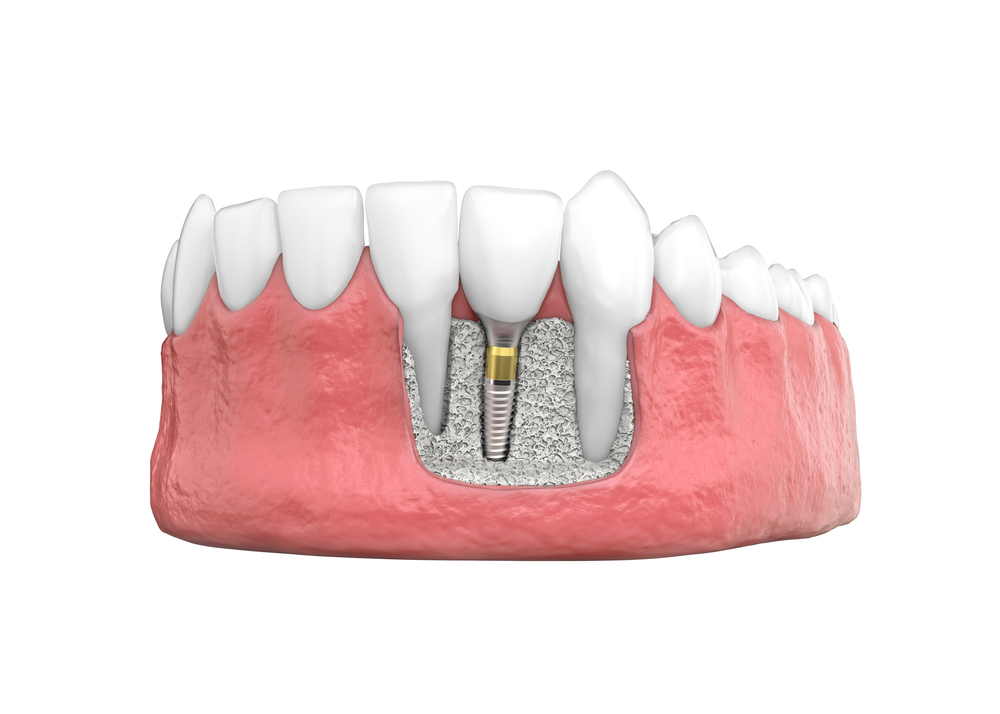 How Bone Grafting with a Cosmetic Dentist Can Help for Dental Implant Patients