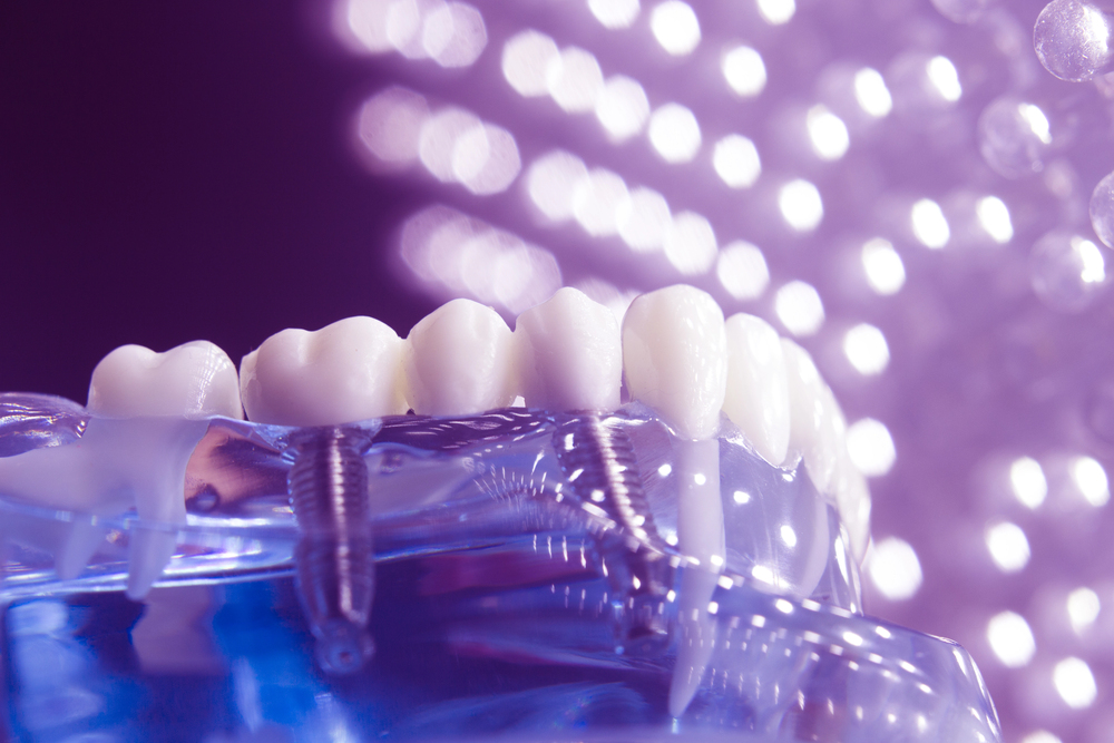 Four Reasons to Consider Single-Tooth Dental Implants