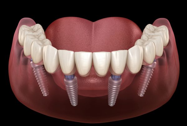 All On 4 Dental Implants Dr. Mistry Dentistry
