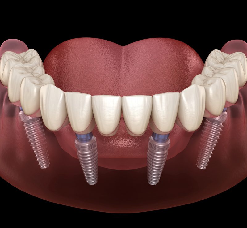 All On 4 Dental Implants Dr. Mistry Dentistry