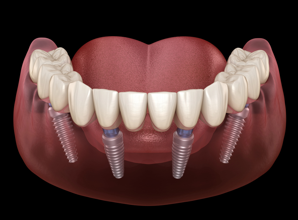 All On 4 Dental Implants