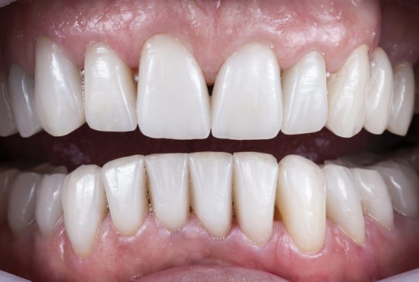 All On 6 Dental Implants Dr. Mistry Dentistry Guelph Ontario