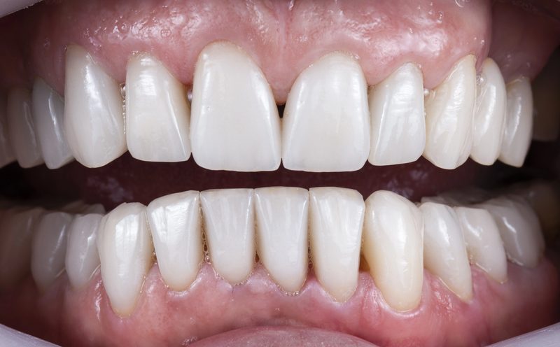 All On 6 Dental Implants Dr. Mistry Dentistry Guelph Ontario