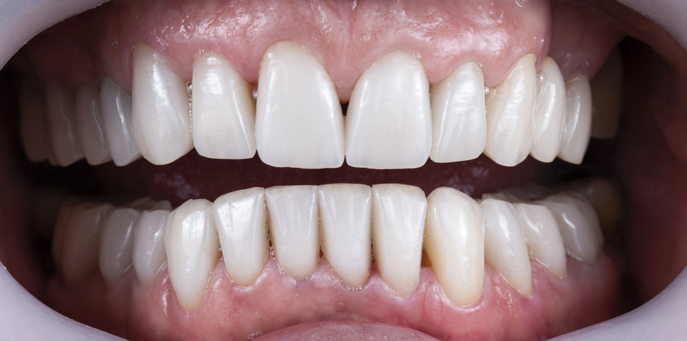 All On 6 Dental Implants