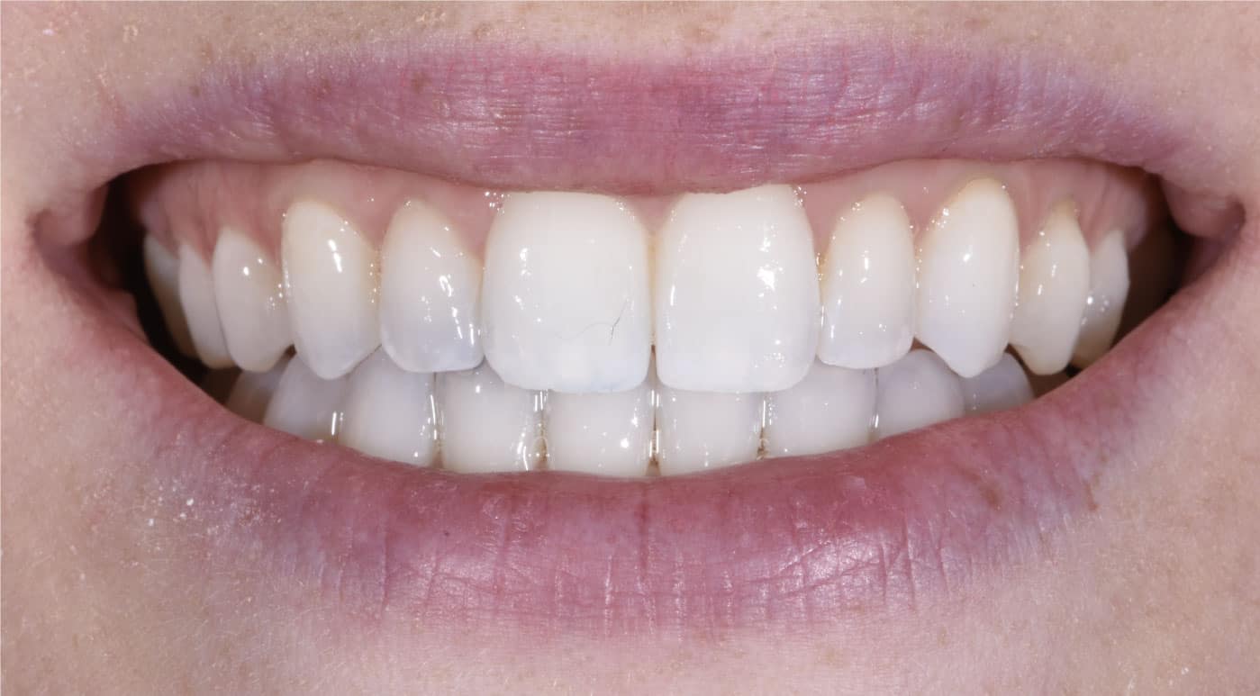 After Invisalign Dr. Mistry Dentistry