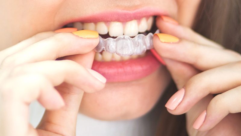 Orthodontic Treatment Dr. Mistry Dentistry