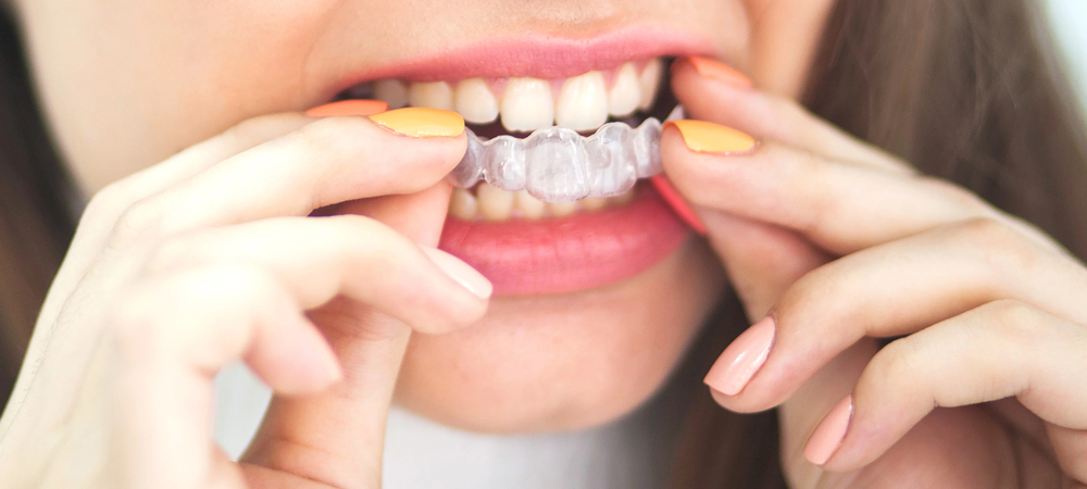 Orthodontic Treatment in Guelph