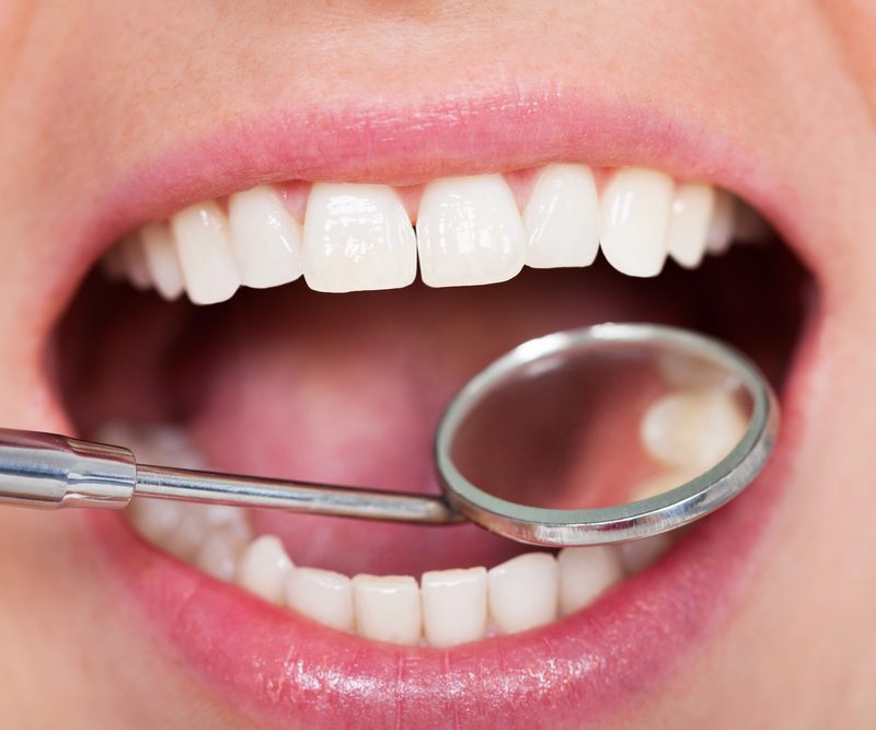 Tooth Fillings in Guelph Ontario Dr. Msitry Dentistry
