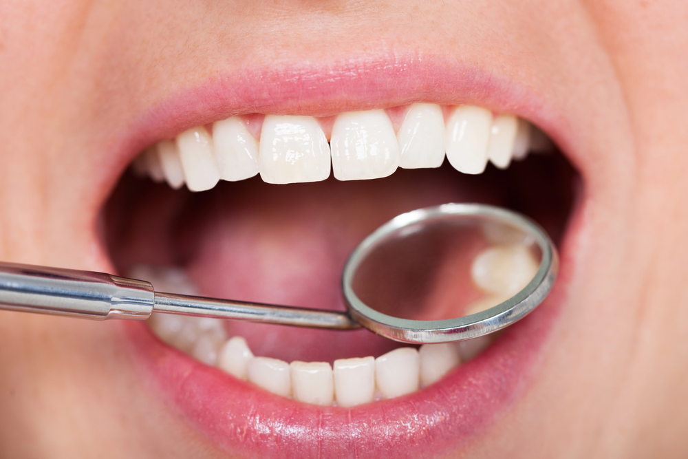 Tooth Fillings In Guelph