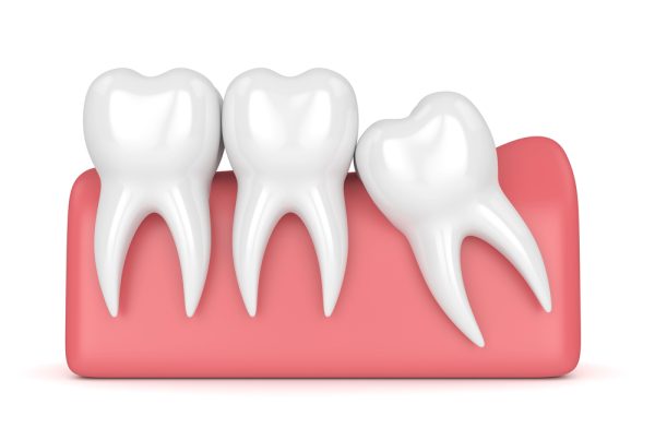 Wisdom Tooth Extraction Dr. Mistry Dentistry