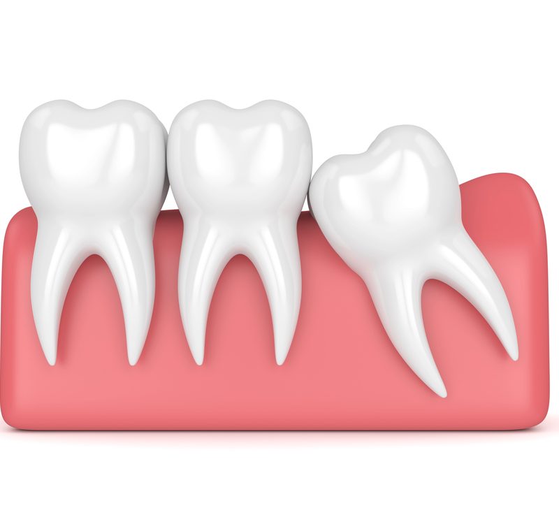 Wisdom Tooth Extraction Dr. Mistry Dentistry