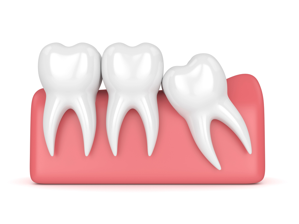 Wisdom Tooth Extraction in Guelph
