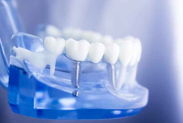 dental implants in Guelph Dr. Mistry Dentistry