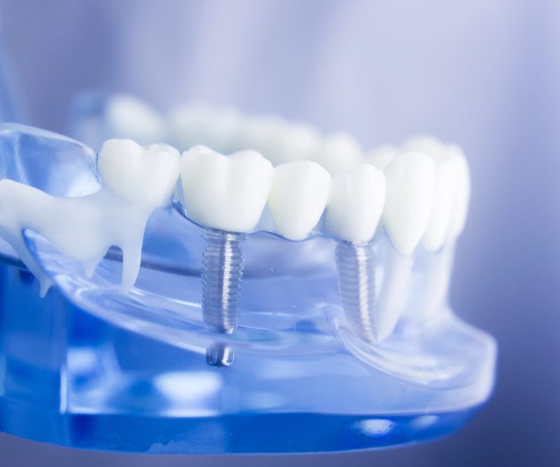 dental implants in Guelph Dr. Mistry Dentistry