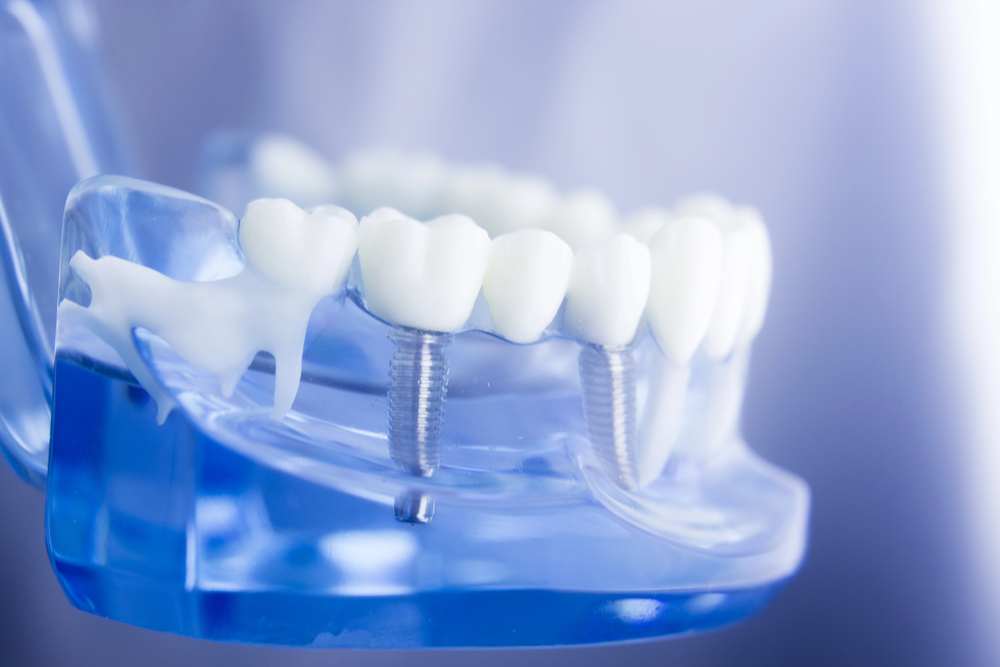 Dental Implants in Guelph