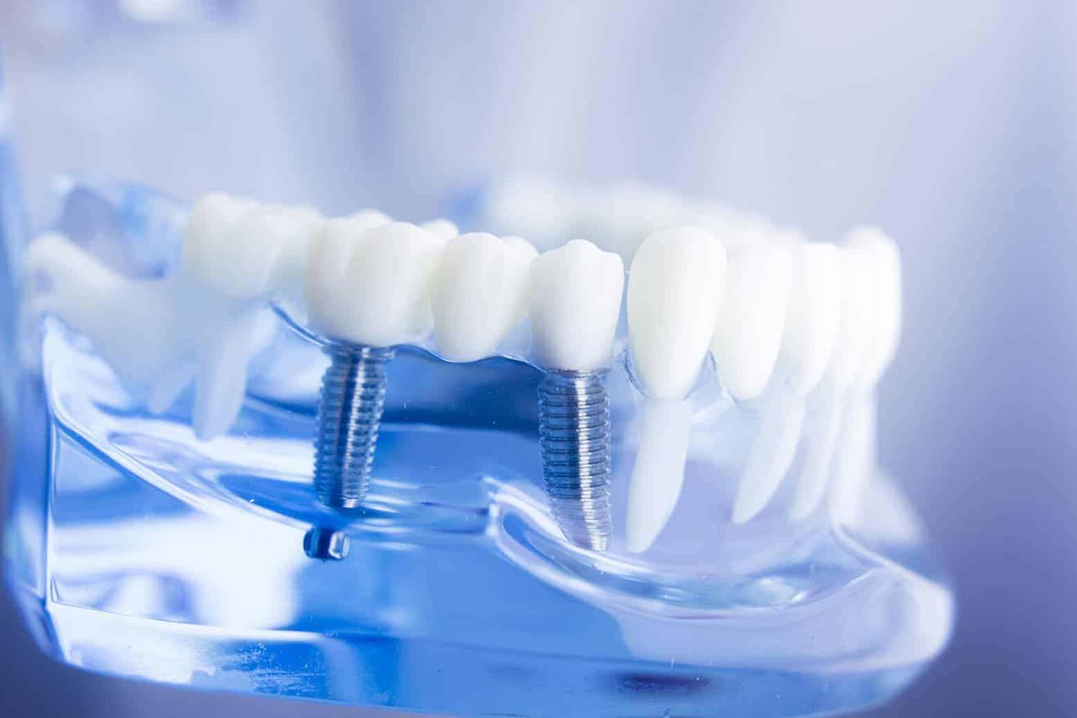 Dental Implants in Guelph