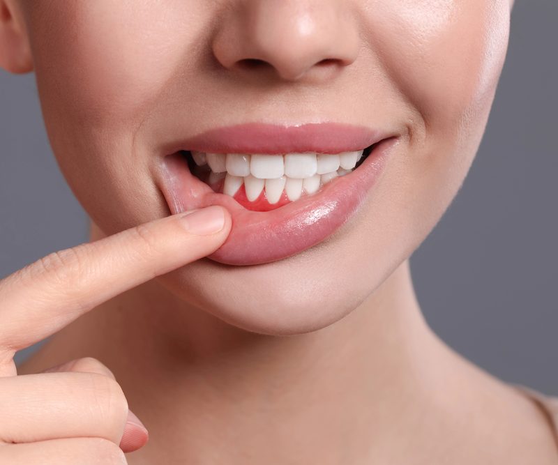 Periodontal Disease Treatment Dr. Mistry Dentistry